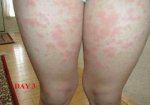 lamitical%20rash.jpg