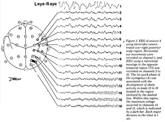 eeg--vestibular-epilepsy.jpg