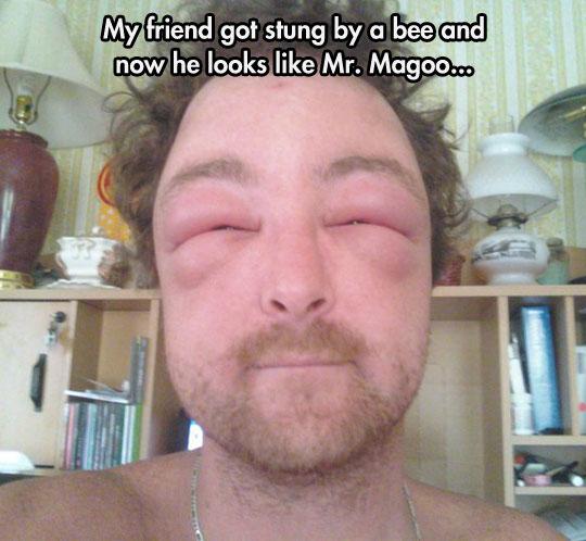 funny-swollen-face-bee-sting-1.jpg